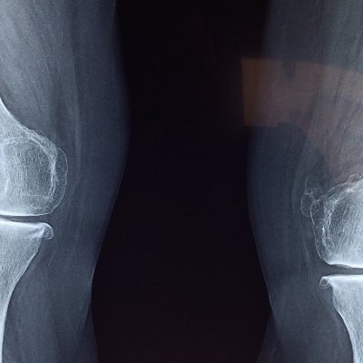 Preventing and Improving Knee Pain